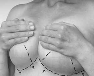 Chirurgie Seins Tunisie Réduction Mammaire